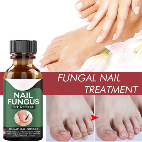 Nail Fungal Treatment Serum, Fungus Removal Gel Paronychia Onychomycosis